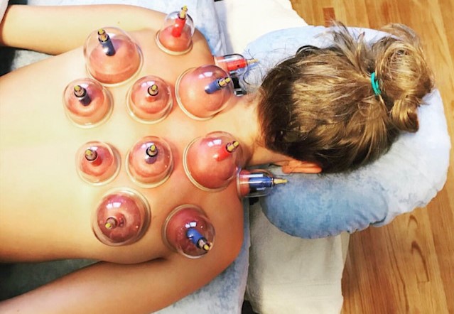 Cupping