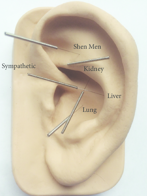 Auricular Therapy – NADA Protocol